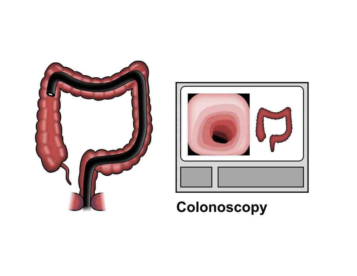 Quelle est la différence entre une coloscopie et une endoscopie ?