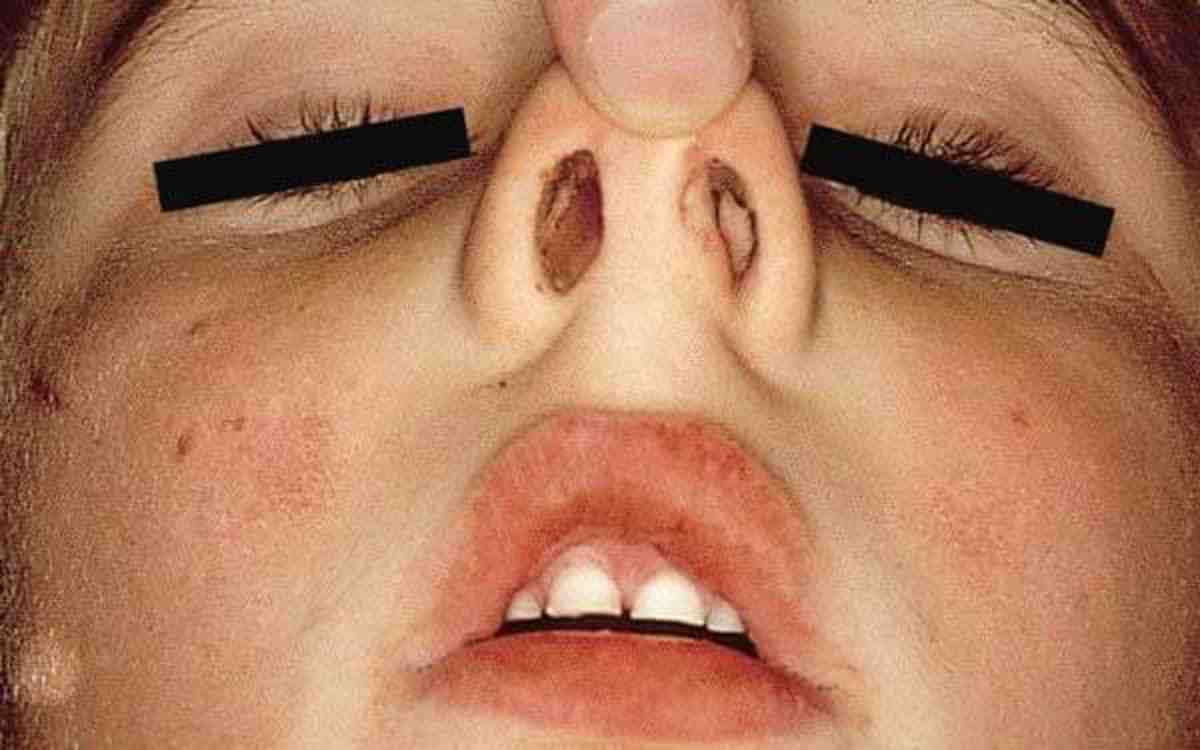 Quelles sont les maladies du nez ?